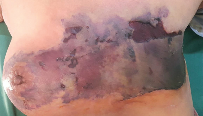 Necrotizing Fasciitis of Bilateral Breasts following Unilateral Modified Radical Mastectomy for Invasive Ductal Carcinoma: A Case Report and Review of Literature.