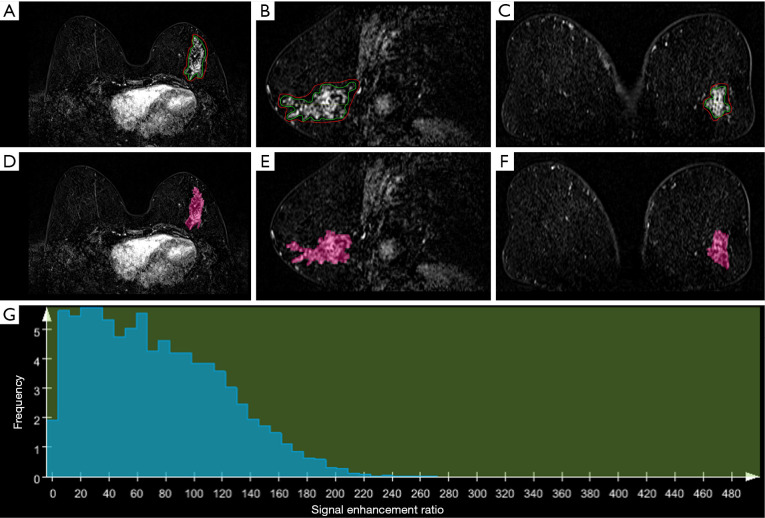 Improved diagnostic value of whole-lesion histogram and texture analyses on multiparametric breast MRI for papillary neoplasms with non-mass enhancement.