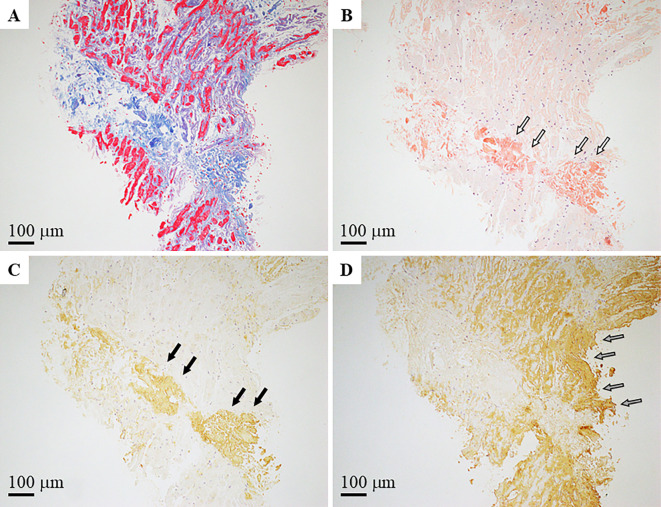 Concurrent Therapy for Immunoglobulin Light Chain Cardiac Amyloidosis and Transthyretin Cardiac Amyloidosis.