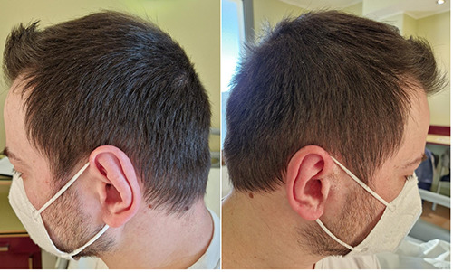 Growth hormone deficiency and secondary adrenal insufficiency in petrified ear syndrome: a case report and literature review.