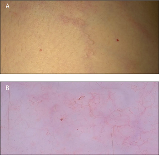 Skin infection by larva migrans and scabies mites: case reports on unusual skin localizations.