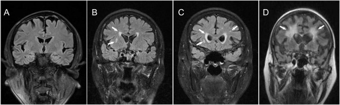 The expression and association of MATK in chronic hypoperfusion patients with white matter hyperintensity.