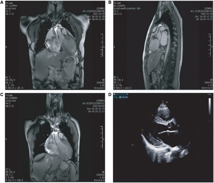 Restrictive cardiomyopathy due to new mutation in the ACTN2 gene: a case report.