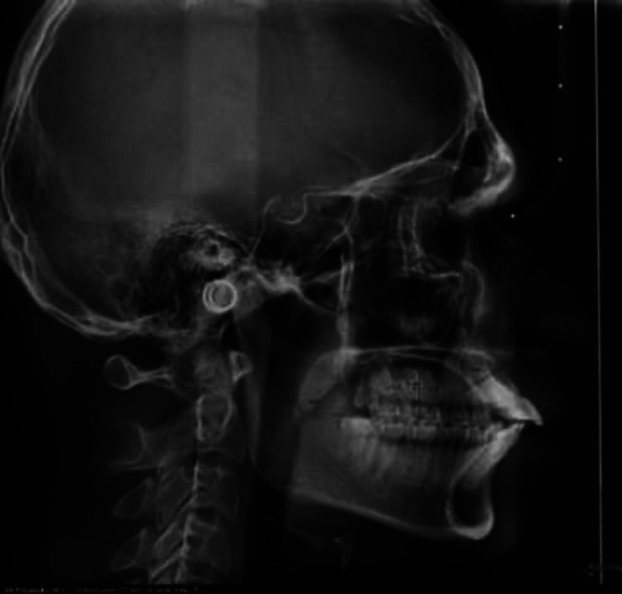Evaluation of the association between tongue posture and the transverse dental compensation in Class III skeletal patients - a retrospective, record-based study.