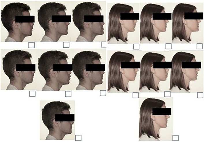 Perceptions on Facial Profile Aesthetics: A Survey of Young People and Orthodontists.