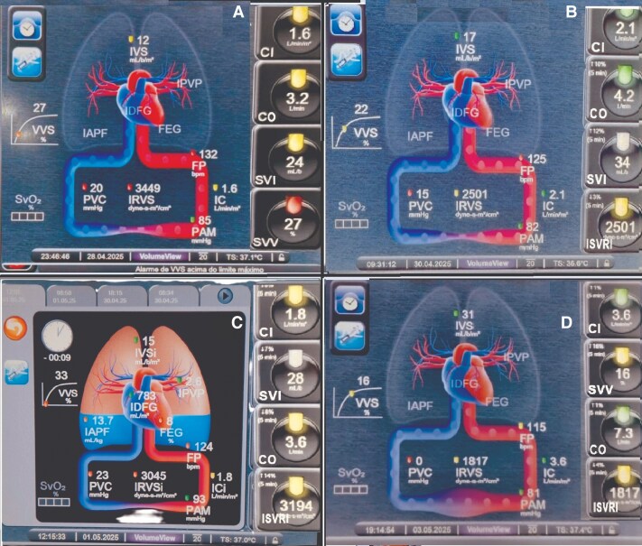 Staggered use of sodium nitroprusside and levosimendan in a patient with refractory cardiogenic shock: a case report.