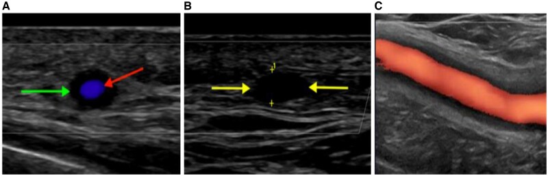 A prospective cohort study evaluating the role of quantifying sonographic inflammatory changes in GCA.