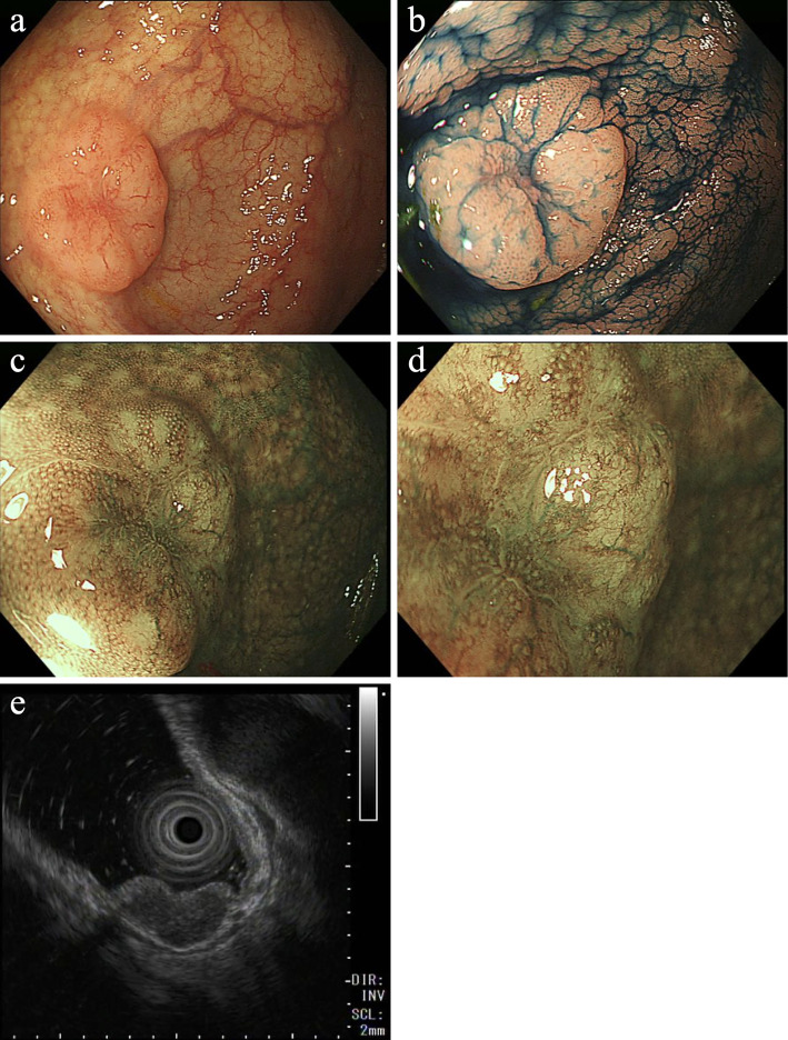 Helicobacter pylori-positive Colorectal MALT Lymphoma with Repeated Metachronous Recurrence after a Complete Response to Eradication Therapy and Regression after a Watch-and-wait Strategy.