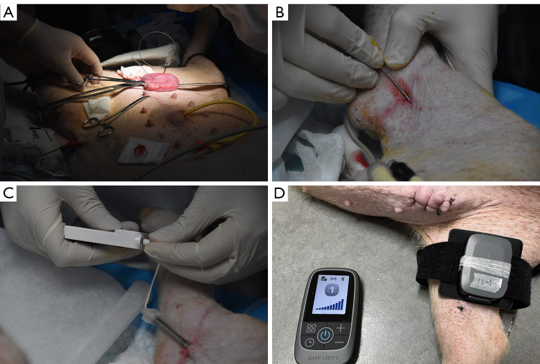 Effect of a novel implantable tibial nerve stimulation system on overactive bladder in pigs.