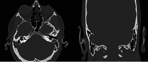 Growth hormone deficiency and secondary adrenal insufficiency in petrified ear syndrome: a case report and literature review.