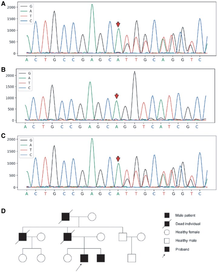 Restrictive cardiomyopathy due to new mutation in the ACTN2 gene: a case report.
