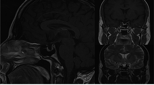 Growth hormone deficiency and secondary adrenal insufficiency in petrified ear syndrome: a case report and literature review.