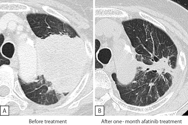 The Afatinib Response to EGFR E709G-mutated Lung Cancer.