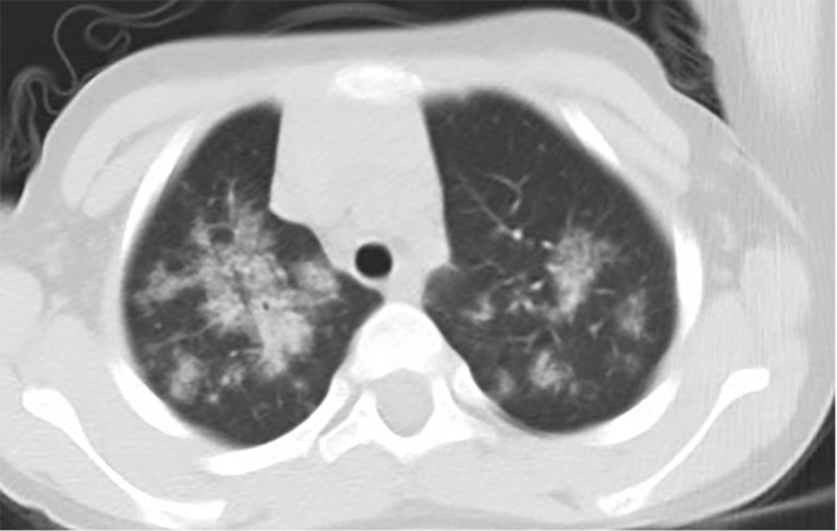 Age at disease onset is an independent risk factor for physical growth of children with idiopathic pulmonary hemosiderosis.