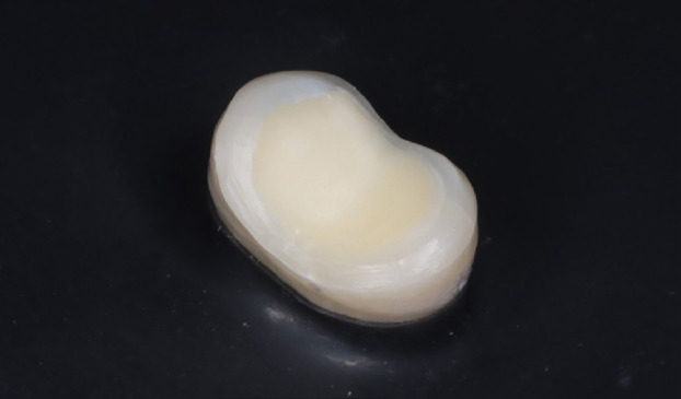 Influences of different fiber-reinforced biobases on the fracture strength and failure mode of lithium disilicate overlay restorations (a comparative <i>in vitro</i> study).