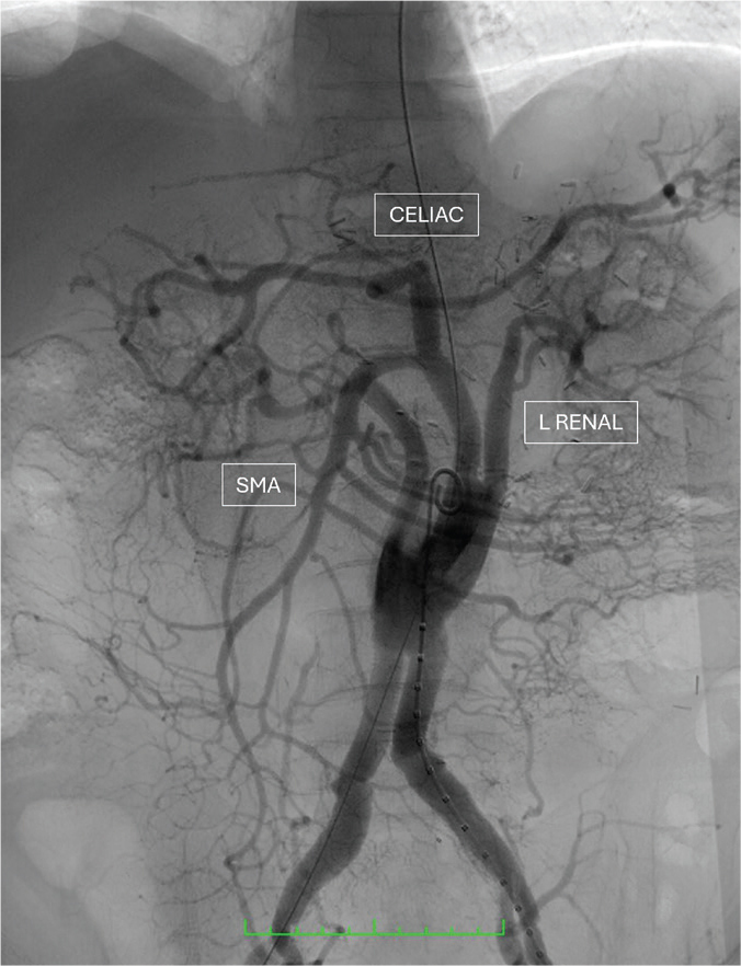 Hybrid Repair for Complex Thoracoabdominal and Pararenal Aortic Aneurysms in High-Risk Patients: A Case Series.