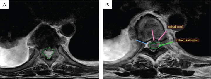 Spinal Extramedullary Hematopoiesis Causing Spinal Cord Compression in Radiation-induced Bone Marrow Aplasia: A Case Report.