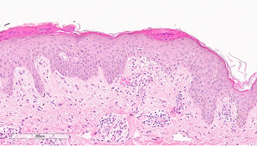Purpuric pityriasis rosea in patients with anorexia nervosa.