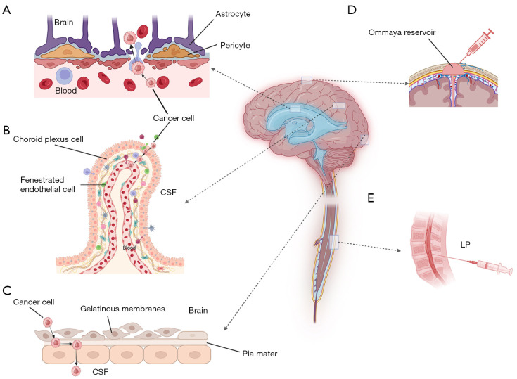 Advances in the research of leptomeningeal metastases in non-small cell lung cancer: a narrative review.