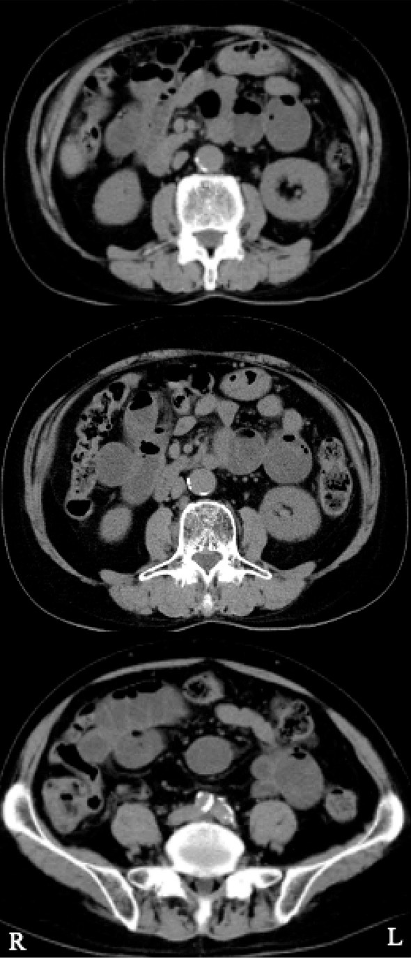 Paralytic Ileus Following Long-term Erenumab Treatment.