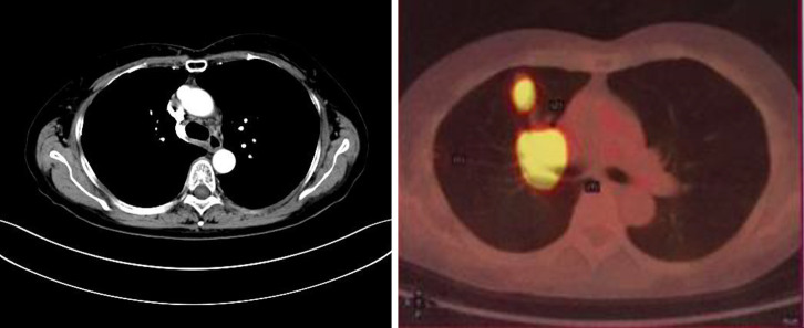 Long-term survival with adaptive dual-targeted therapy in an epidermal growth factor receptor (<i>EGFR</i>)-mutant non-small cell lung cancer patient with mesenchymal-epithelial transition (<i>MET</i>) amplification guided by minimal residual disease (MRD) assessments: a case report and literature review.