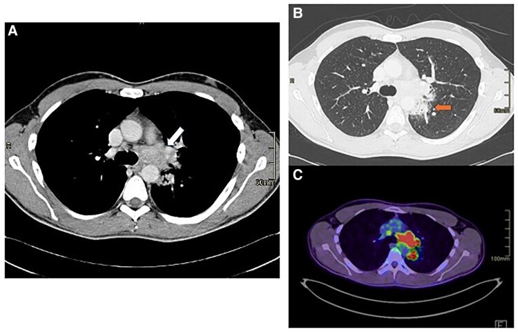 Cardiac magnetic resonance as the key to uncovering unusual disseminated histoplasmosis: a case report.