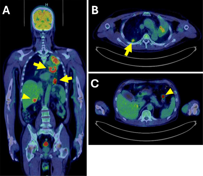 Post-Transplant Lymphoproliferative Disorder Which Developed 45 Years After Kidney Transplantation.