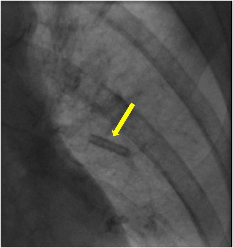 Permanent pacemaker implantation complicated by anchoring sleeve embolization through cephalic vein: case report and discussion of management strategies.
