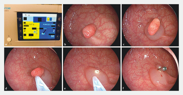 Comparison of three electrosurgical modes for endoscopic mucosal resection of 10- to 20-mm colorectal polyps: Randomized controlled trial.