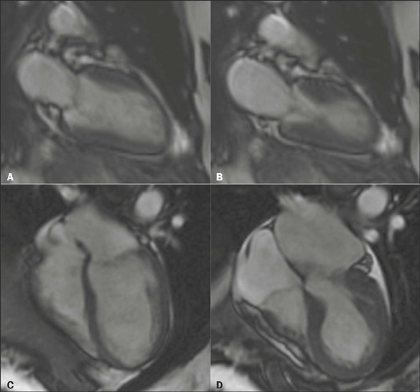The spectrum of imaging findings in takotsubo cardiomyopathy: a pictorial essay.