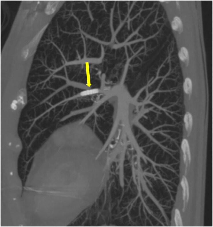 Permanent pacemaker implantation complicated by anchoring sleeve embolization through cephalic vein: case report and discussion of management strategies.