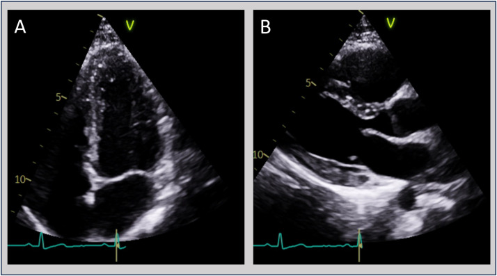 From gut to heart: Salmonella gastroenteritis complicated by myocarditis: a case report.