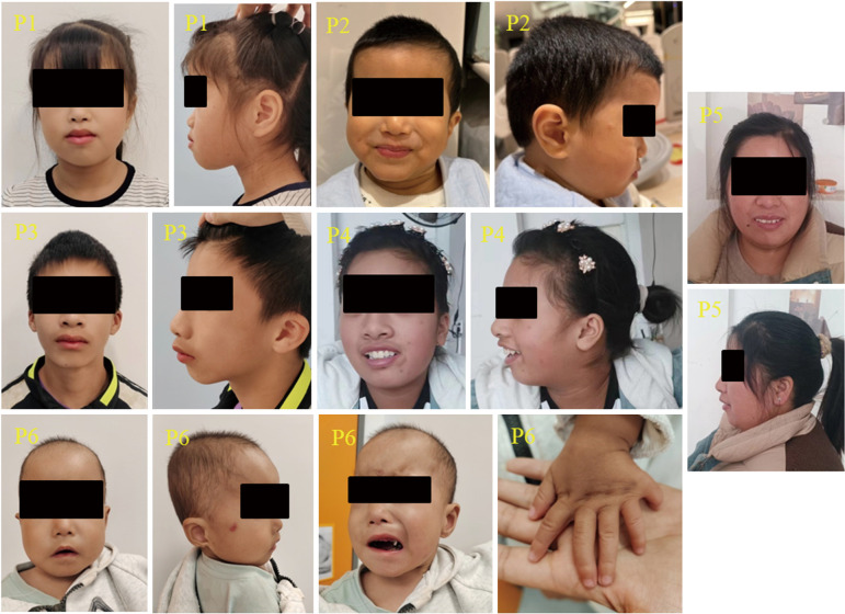 Novel variants in <i>ZNF462</i> and phenotype update in patients with Weiss-Kruszka syndrome: a case series.