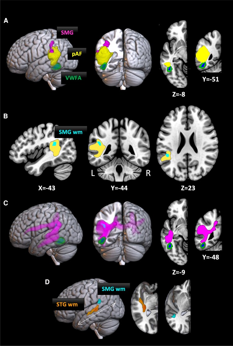 Bridging speech and sight: white matter anatomy in ticker-tape synaesthesia.