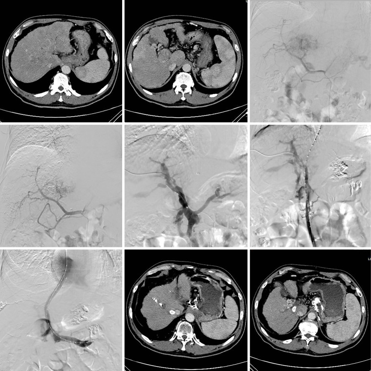 Clinical significance of transjugular intrahepatic portosystemic shunting for hepatocellular carcinoma complicated with portal hypertension.
