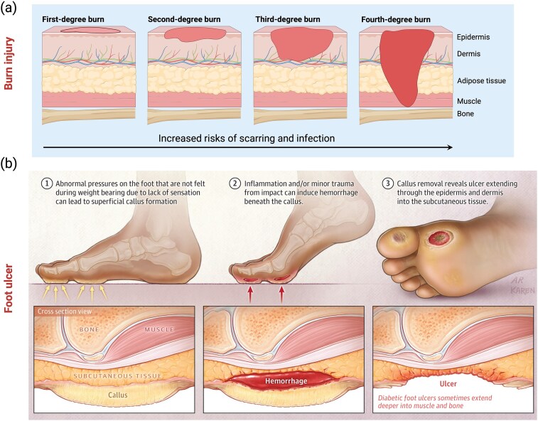 Advancing injectable hydrogels for wound treatment: targeted control of oxidative stress toward personalized regeneration.
