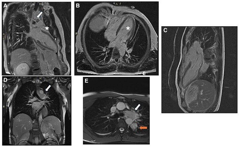 Cardiac magnetic resonance as the key to uncovering unusual disseminated histoplasmosis: a case report.