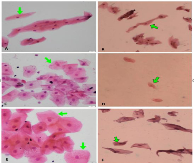 Cryotherapy on exfoliative cytological changes for oral mucositis in cancer patients undergoing chemotherapy: A randomized control trial.