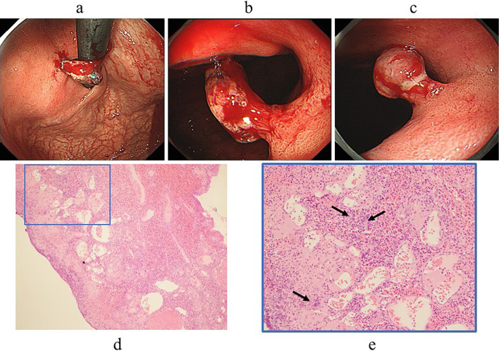Rapid Development of a Hemorrhagic Hyperplastic Polyp in a Patient with Evolving Autoimmune Gastritis after Helicobacter pylori Eradication.