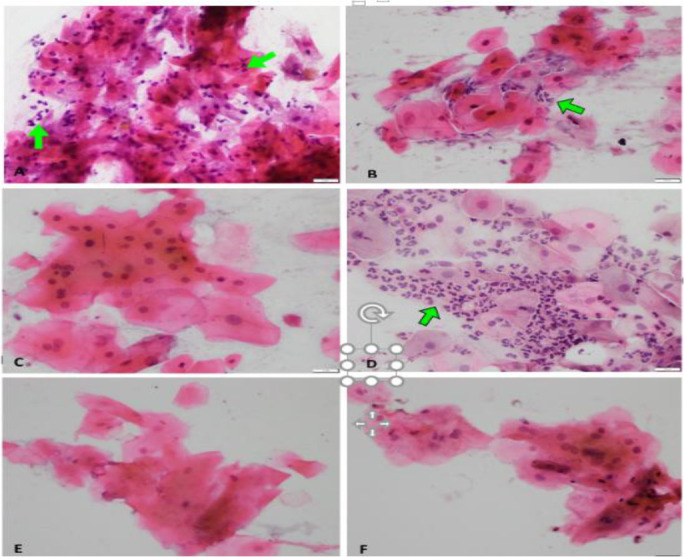 Cryotherapy on exfoliative cytological changes for oral mucositis in cancer patients undergoing chemotherapy: A randomized control trial.