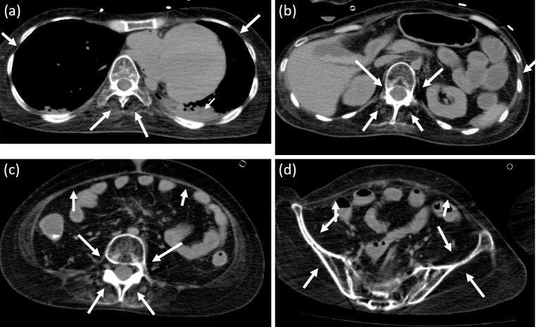Duchenne Muscular Dystrophy with Extreme Emaciation and a Discrepancy between Cystatin C-based eGFR and Inulin Clearance.