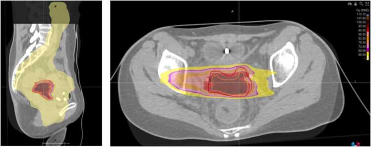 Long-Term Tumor Control After Carbon Ion Radiation Therapy Boost in Locally Advanced Cervical Clear Cell Adenocarcinoma.