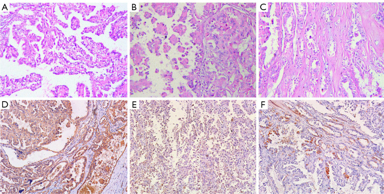 Comparative analysis of clinicopathological characteristics and prognostic outcomes in fumarate hydratase-deficient renal cell carcinoma versus high-grade papillary renal cell carcinoma.