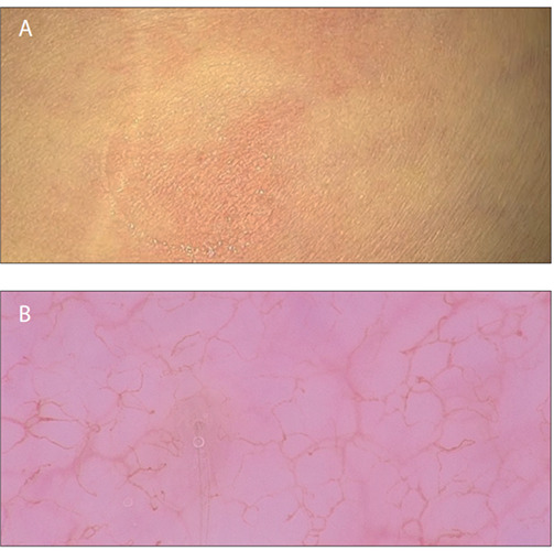 Skin infection by larva migrans and scabies mites: case reports on unusual skin localizations.