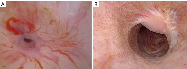 Endoscopic buccal urethroplasty for membranous stricture disease.
