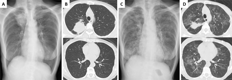 Successful Switch to Afatinib and Osimertinib Rechallenge with Corticosteroids after Osimertinib-induced Interstitial Lung Disease: A Case Report and Literature Review.