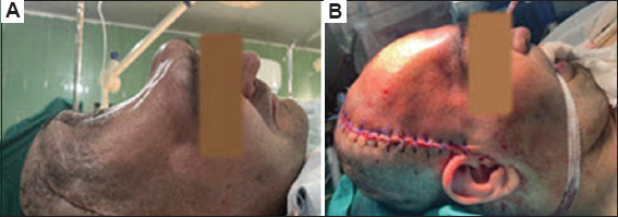 A customized large single-piece bifrontal implant for post-craniectomy defect reconstruction: A case study.