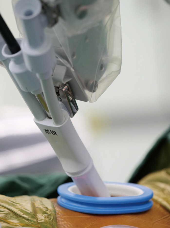 Complex uniportal robotic-assisted sleeve resections under spontaneous ventilation and with double lumen intubation: a case series and a narrative review of the literature.