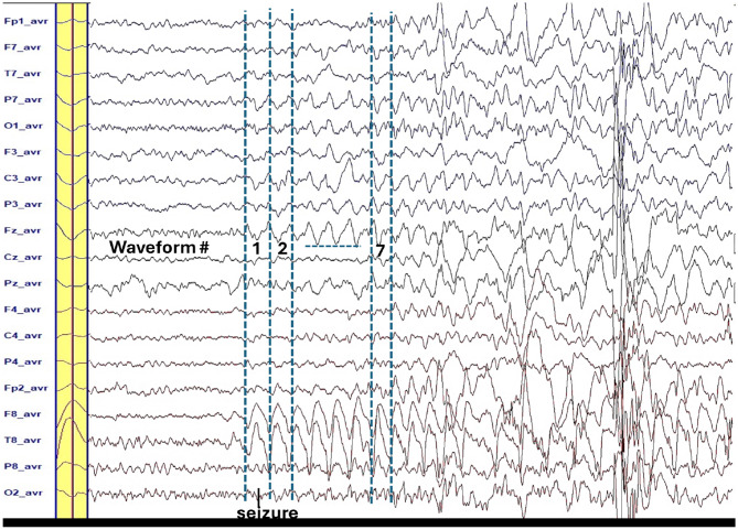 Epileptic brain imaging by source localization CLARA supported by ictal-based semiology and VEEG in resource-limited settings.