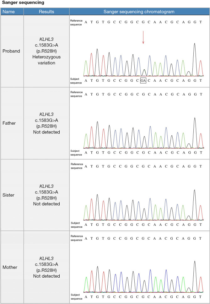 A case report of Graves' disease combined with pseudohypoaldosteronism type IID in a child.